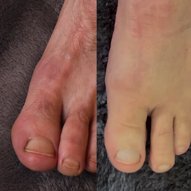 Onychom – Aparat Laser Anti-Micoză Unghială